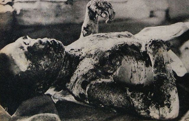 Victim of Hiroshima atomic bombing 3